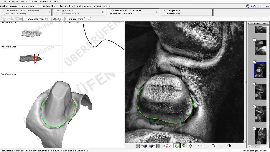 Scanner Aufnahme Digitale Abformung